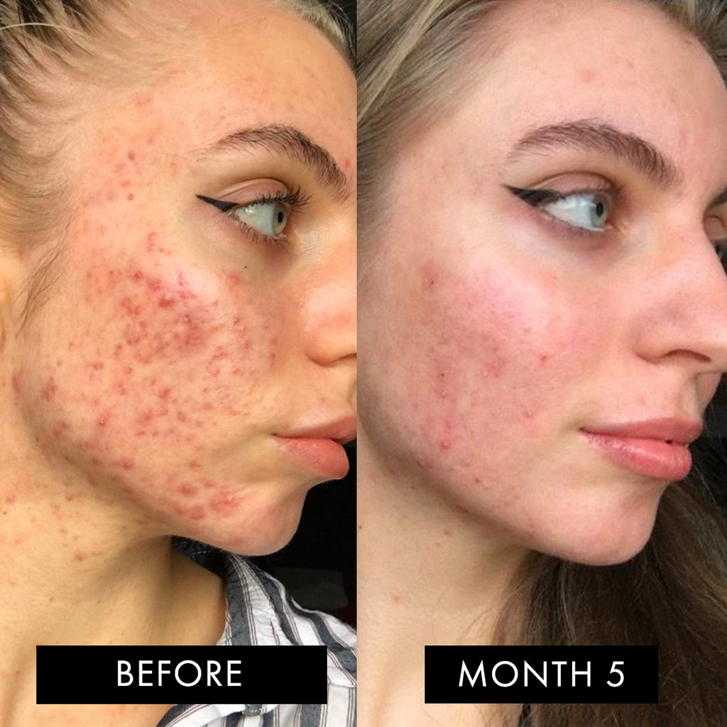 The Skin Elixir Three Month Pack